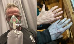 Sabah uyandığında vücudu tamamen maviye döndü! Doktorlar bile şakına döndü