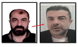 Ameliyat ile yüzünü değiştiren firari cinayet zanlısı, 7 yıl sonra yakalandı