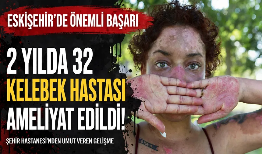 Eskişehir'de kelebek hastalığına karşı önemli başarı